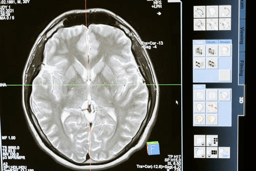 meditation changes the brain